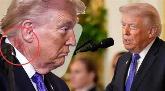 بقعة حمراء على رقبة ترامب.. وطبيبه يوضح بقعة حمراء على رقبة ترامب.. وطبيبه يوضح