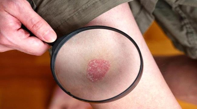 دراسة تكشف طريقة فعّالة لتقليل أعراض الصدفية دراسة تكشف طريقة فعّالة لتقليل أعراض الصدفية